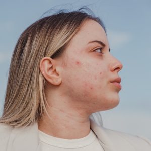 Manchas: La ruta para despigmentarlas